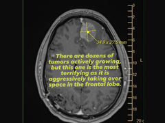Michael Prinke MRI-felvétele, amelyet felesége töltött fel a közösségi médiára