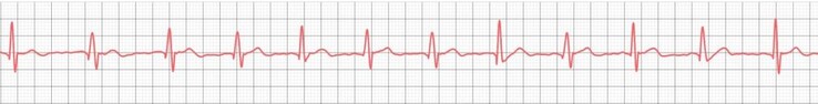 Még az olcsóbb okosórák is bebizonyították, hogy képesek az alapvető EKG-felvételek sikeres rögzítésére