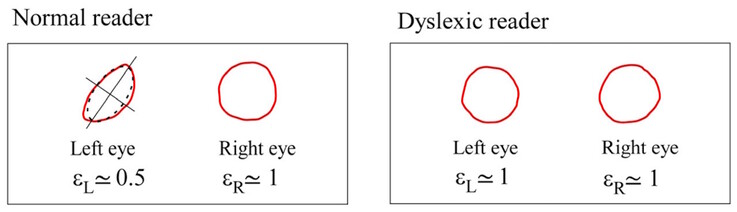 A Maxwell-centroidok szimmetriája normális alanyoknál eltér, de diszlexiás alanyoknál hasonló. (A kép forrása: DOI 10.3390/brainsci13101478) 